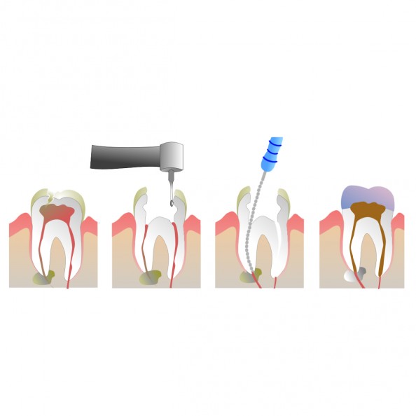tratamiento-conducto